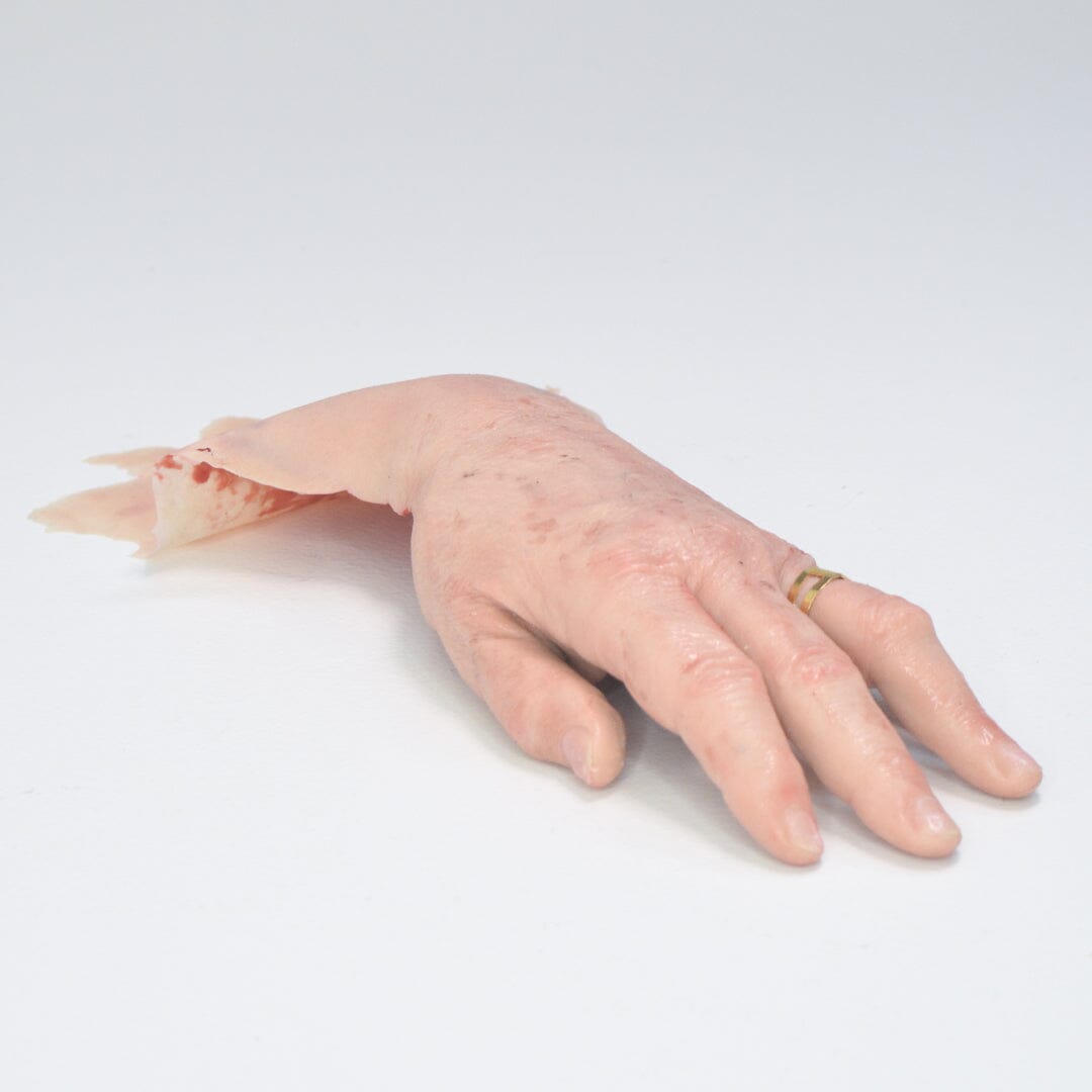 Degloved Hand Injury